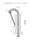 MINIMALLY INVASIVE DISCECTOMY diagram and image