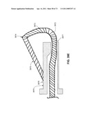 MINIMALLY INVASIVE DISCECTOMY diagram and image