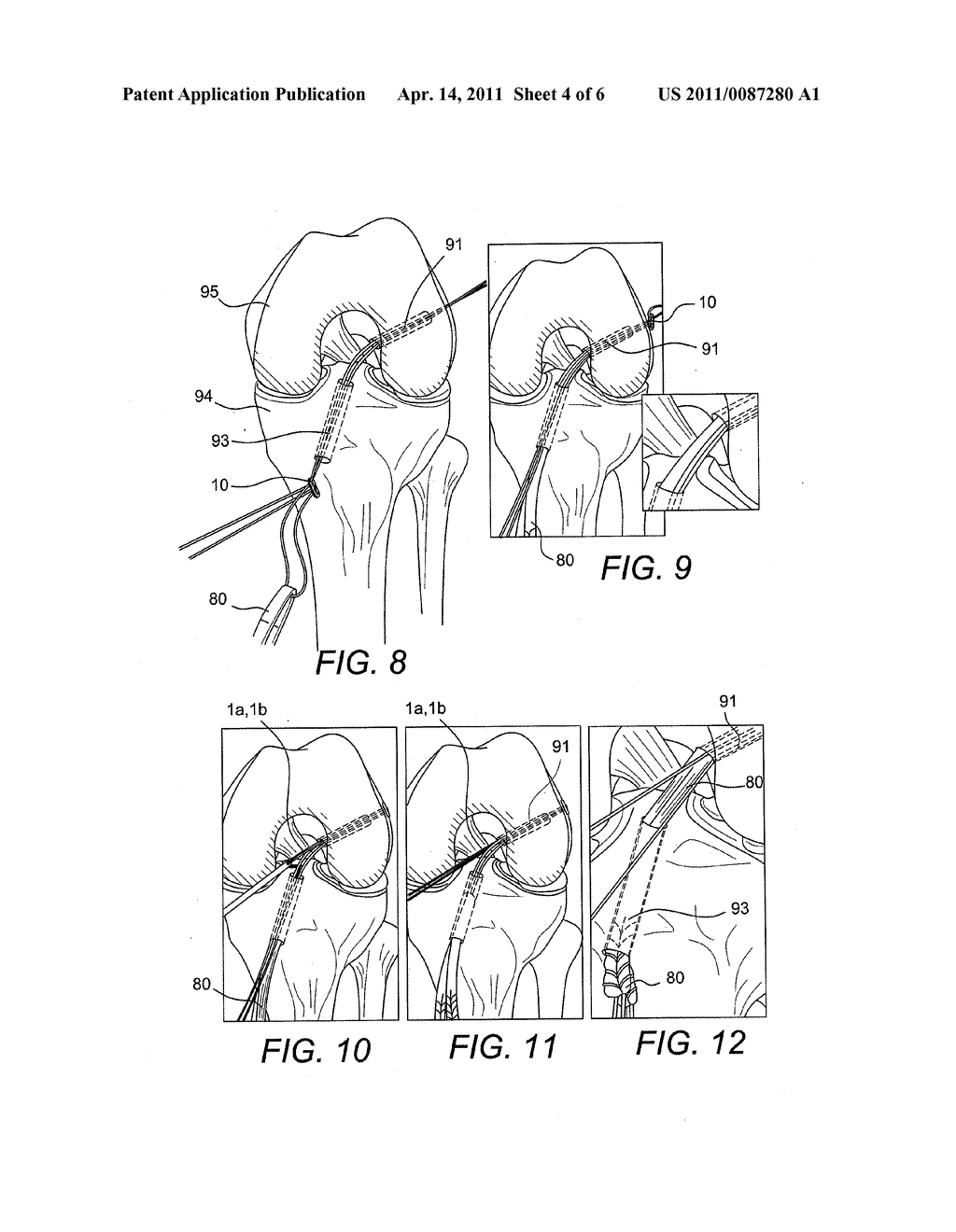 Z-SHAPED BUTTON FOR TISSUE REPAIR - diagram, schematic, and image 05