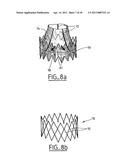 Method of Treating Aortic Stenosis Using an Implantable Prosthetic Valve diagram and image