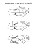 Method of Treating Aortic Stenosis Using an Implantable Prosthetic Valve diagram and image