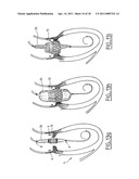 Method of Treating Aortic Stenosis Using an Implantable Prosthetic Valve diagram and image