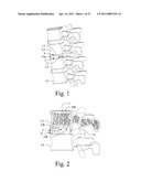 LUMBAR IMPLANT diagram and image