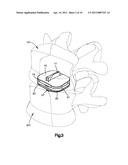 ARTICULATING DISC IMPLANT diagram and image