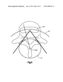 ARTICULATING DISC IMPLANT diagram and image