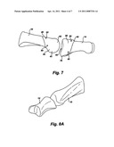 ARTIFICIAL TOE JOINT diagram and image