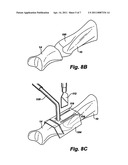 ARTIFICIAL TOE JOINT diagram and image