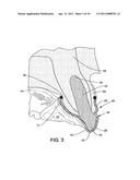 CUSTOM MOUTHGUARD diagram and image