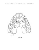 CUSTOM MOUTHGUARD diagram and image