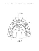 CUSTOM MOUTHGUARD diagram and image