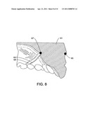 CUSTOM MOUTHGUARD diagram and image