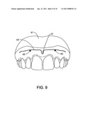 CUSTOM MOUTHGUARD diagram and image