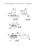 METHODS FOR FORMING IMPLANTS WITH SELECTIVELY EXPOSED MESH FOR FIXATION AND RELATED IMPLANTS diagram and image