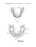 Orthodontic appliance diagram and image