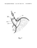 BARIATRIC DEVICE AND METHOD diagram and image