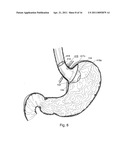 BARIATRIC DEVICE AND METHOD diagram and image