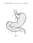 BARIATRIC DEVICE AND METHOD diagram and image