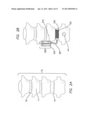 Remotely Activated Piezoelectric Pump for Delivery of Biological Agents to the Intervertebral Disc and Spine diagram and image