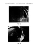 IMMUNOISOLATION PATCH SYSTEM FOR CELLULAR TRANSPLANTATION diagram and image