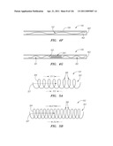 SYSTEMS AND METHODS FOR TREATING SEPTAL DEFECTS diagram and image