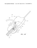 SYSTEMS AND METHODS FOR TREATING SEPTAL DEFECTS diagram and image