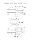 SYSTEMS AND METHODS FOR TREATING SEPTAL DEFECTS diagram and image