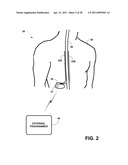 PROGRAMMING TECHNIQUES FOR STIMULATION WITH UTILIZATION OF CASE ELECTRODE diagram and image