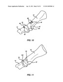 ARTIFICIAL JOINT PRESERVING TENDON AND/OR SESAMOID BONE STRUCTURE diagram and image