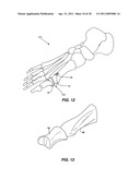 ARTIFICIAL JOINT PRESERVING TENDON AND/OR SESAMOID BONE STRUCTURE diagram and image