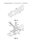 ARTIFICIAL JOINT PRESERVING TENDON AND/OR SESAMOID BONE STRUCTURE diagram and image