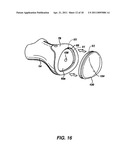 ARTIFICIAL JOINT PRESERVING TENDON AND/OR SESAMOID BONE STRUCTURE diagram and image