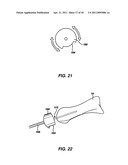 ARTIFICIAL JOINT PRESERVING TENDON AND/OR SESAMOID BONE STRUCTURE diagram and image