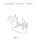 DENTAL APPLIANCE AND METHODS OF USING THE SAME diagram and image
