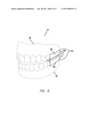 DENTAL APPLIANCE AND METHODS OF USING THE SAME diagram and image