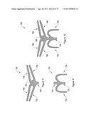 PELVIC FLOOR REPAIR SYSTEM diagram and image