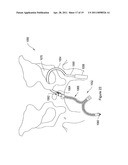 PELVIC FLOOR REPAIR SYSTEM diagram and image