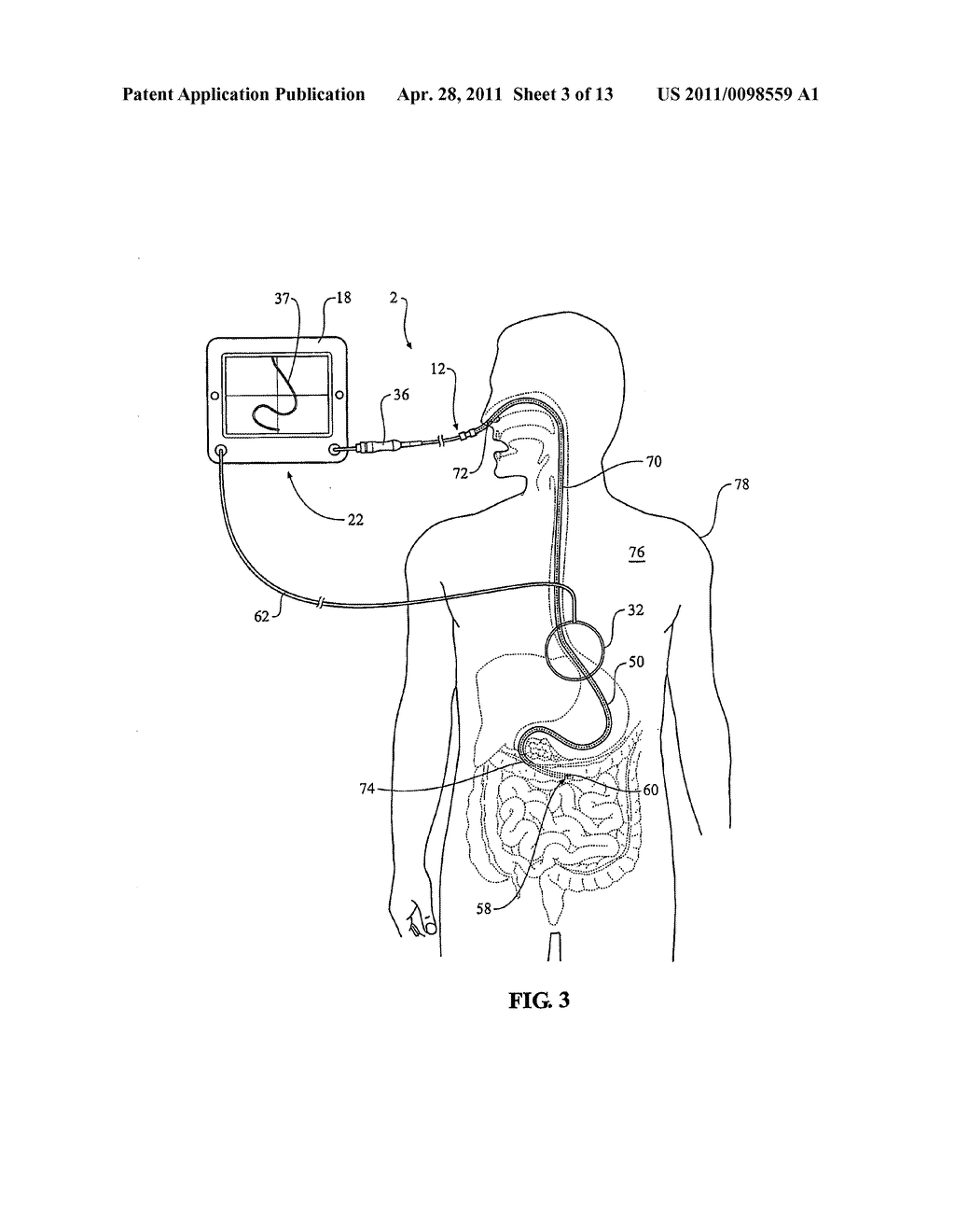 Guiding insert assembly for a catheter used with a catheter position guidance system - diagram, schematic, and image 04