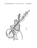 Internal and external disc shunts alleviate back pain diagram and image