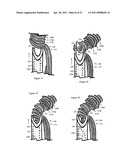 Internal and external disc shunts alleviate back pain diagram and image