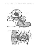 Internal and external disc shunts alleviate back pain diagram and image