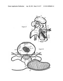 Internal and external disc shunts alleviate back pain diagram and image