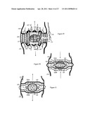 Internal and external disc shunts alleviate back pain diagram and image