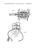 Internal and external disc shunts alleviate back pain diagram and image