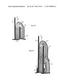 Internal and external disc shunts alleviate back pain diagram and image