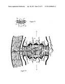 Internal and external disc shunts alleviate back pain diagram and image