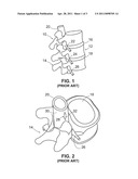 Devices and Methods for Temporarily Retaining Spinal Rootlets within Dural Sac diagram and image