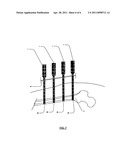 Support arrangement for use in supporting a bone during a surgical operation diagram and image