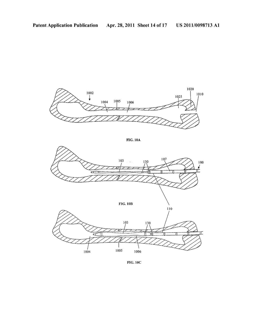 Systems and Methods for Internal Bone Fixation - diagram, schematic, and image 15