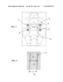 Method For Stabilizing The Spine diagram and image