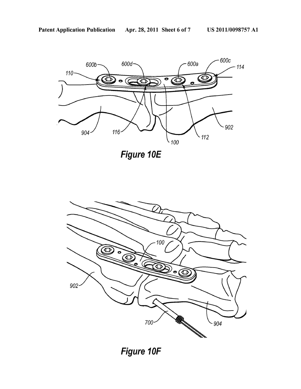 COMPRESSION PLATE KIT AND METHODS FOR REPAIRING BONE DISCONTINUITIES - diagram, schematic, and image 07